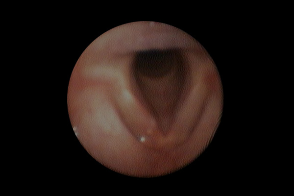 Chirurgie de la voix et chirurgie endoscopique